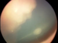 Retinoblastoma tumor