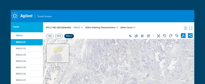 Image of the Online Atlas of Stains for Cervical Cancer: PD-L1 IHC 22C3 pharmDx