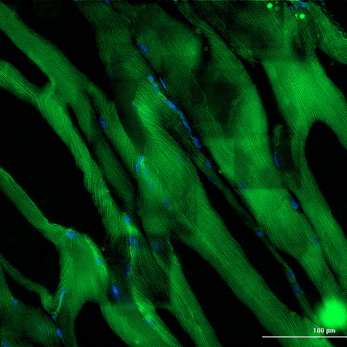 Fatty acid infiltrates in skeletal muscle